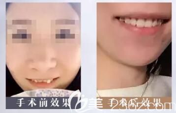 李俊峰牙齒矯正案例