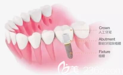 李俊峰分享種植牙