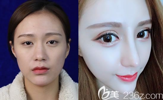 寧波童顏羅遠(yuǎn)洪雙眼皮案例效果 寧波童顏羅遠(yuǎn)洪雙眼皮案例效果