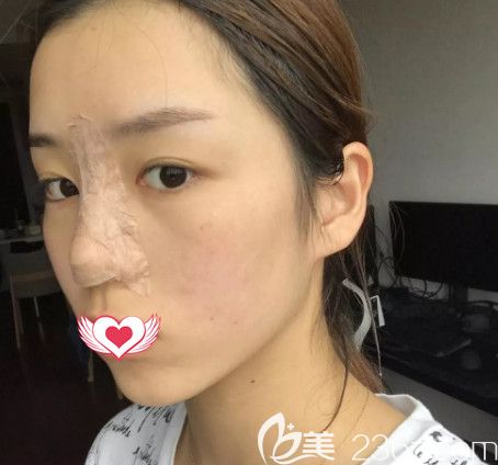 在石家莊雅芳亞做鼻綜合術后3天鼻子微腫 在石家莊雅芳亞做鼻綜合術后3天鼻子微腫