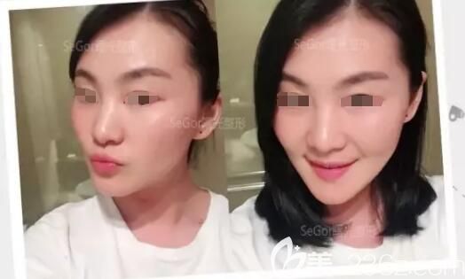 剛注射完瘦臉除皺瘦臉天