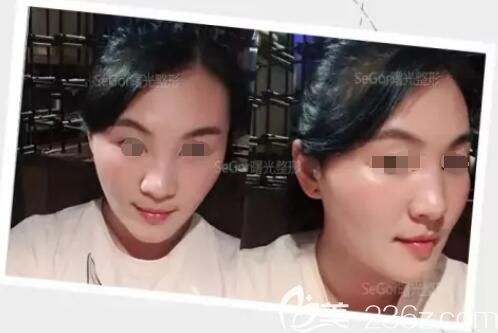 分享瘦臉除皺瘦臉術(shù)后三天蛻變