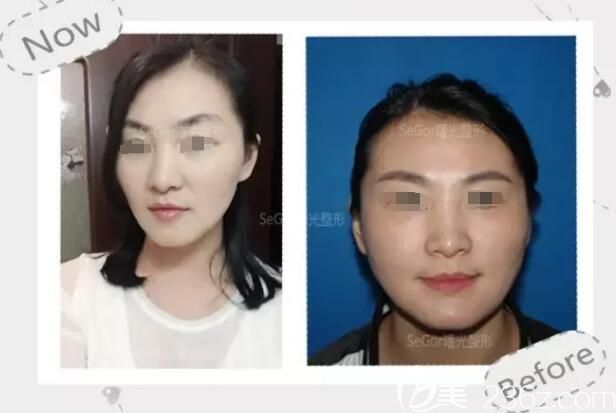 一開始也擔(dān)心瘦臉除皺瘦臉副作用的我，沒想到在常州曙光醫(yī)生親診下嘗試了一次居然想定期注射