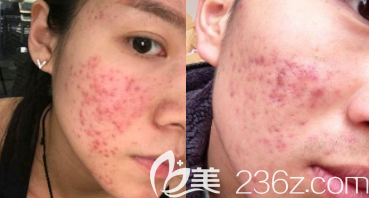 長(zhǎng)痘和痘坑的臉