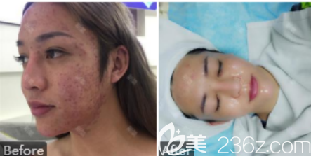 激光治療痘坑的案例一