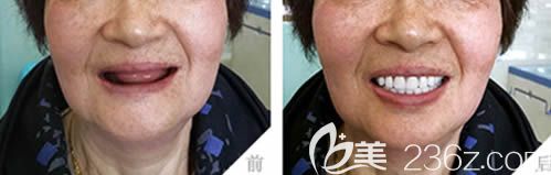 沈陽歡樂口孫乃鶴醫(yī)生全口種植牙案例對比圖 沈陽歡樂口孫乃鶴醫(yī)生全口種植牙案例對比圖