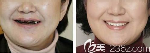 沈陽歡樂口腔徐陽院長全口即刻種植牙前后對比效果 沈陽歡樂口腔徐陽院長全口即刻種植牙前后對比效果
