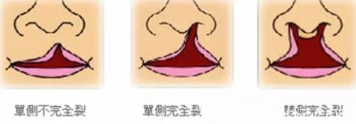 唇裂可以分為三個(gè)等級(jí) 唇裂可以分為三個(gè)等級(jí)