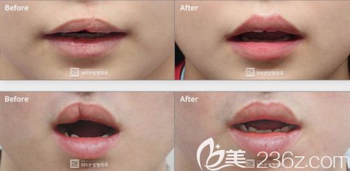 韓國mvp崔宇植院長(zhǎng)修復(fù)二期唇裂疤痕