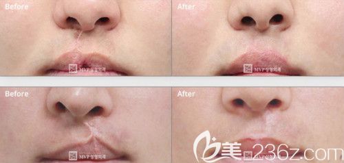 韓國mvp崔宇植院長(zhǎng)修復(fù)二期人中疤痕