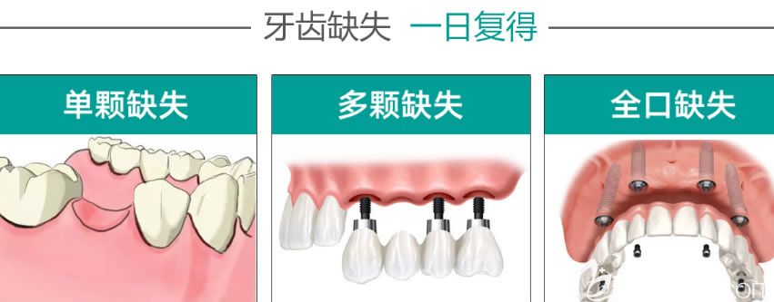 沈陽歡爾口腔即刻種植牙優(yōu)勢 沈陽歡爾口腔即刻種植牙優(yōu)勢