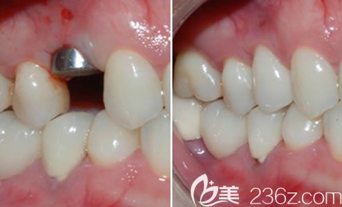 歡樂口腔沈陽分院張桂靜醫(yī)生單顆牙缺失種植案例 歡樂口腔沈陽分院張桂靜醫(yī)生單顆牙缺失種植案例