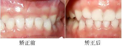 肖春醫(yī)生4歲兒童牙性+骨性地包天矯正前后對比照 肖春醫(yī)生4歲兒童牙性+骨性地包天矯正前后對比照