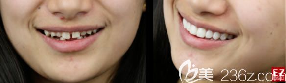 26歲劉女士做完瓷貼面前后對(duì)比照