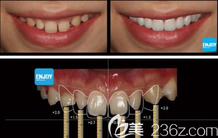 33歲的白女士讓彭醫(yī)生做完DSD美學(xué)瓷貼面后的對(duì)比效果