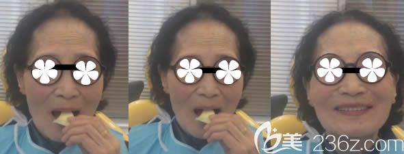 張女士選擇吸附性全口義齒后的效果圖