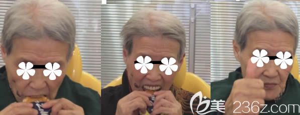 劉女士做完BPS生物功能性全口義齒后的效果