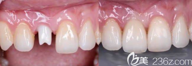 沈陽歡樂口腔李春玲醫(yī)生前門牙全瓷冠修復(fù)效果圖