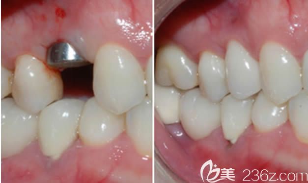 尹國(guó)斌醫(yī)生烤瓷牙損壞后選擇做全瓷冠修復(fù)后的效果圖 尹國(guó)斌醫(yī)生烤瓷牙損壞后選擇做全瓷冠修復(fù)后的效果圖