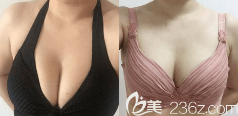 北京<!--<i data=20240703-sp></i>--><!--<i data=20240703-sp></i>-->縮胸手術