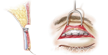 雙眼皮切除脂肪示意圖