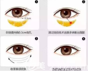 眼袋去除手術
