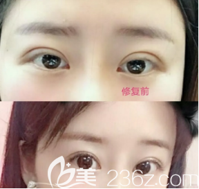 雙眼皮修復案例