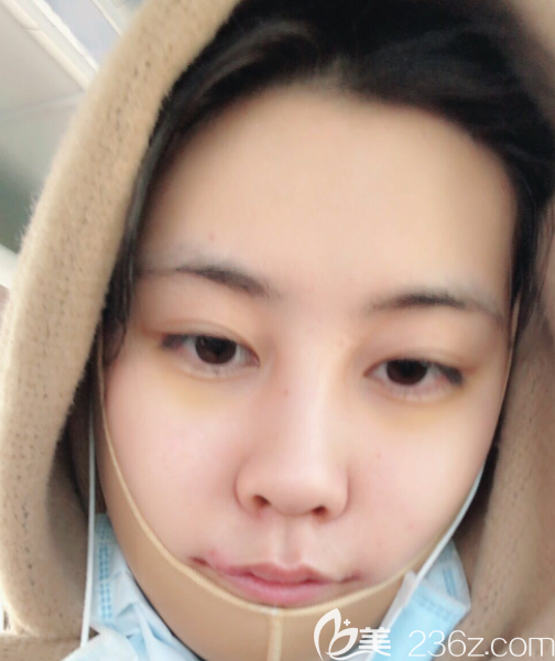 剛拆完膠布后 剛拆完膠布后