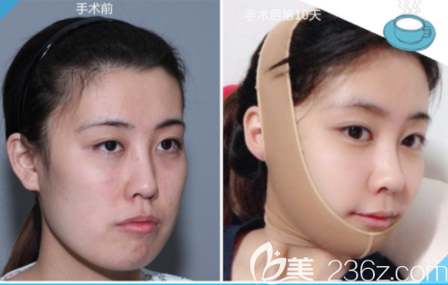 土味博士有內涵更要顏值找首爾UC韓相百做了突嘴齙牙矯正