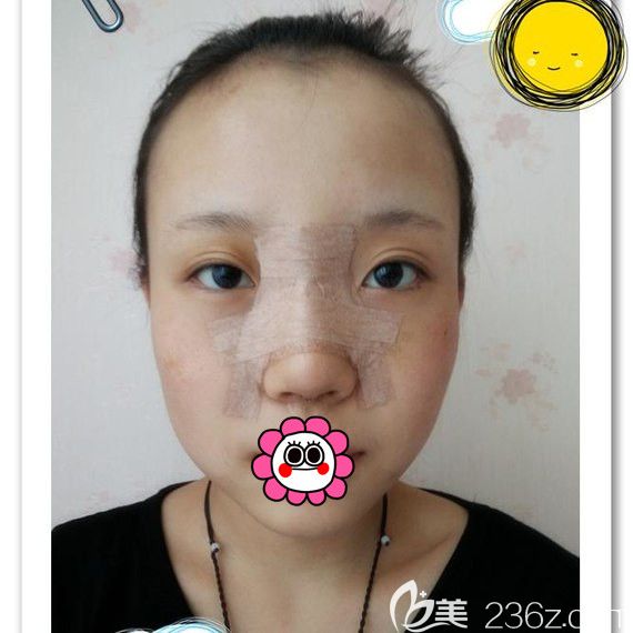 黑龍江瑞麗鼻整形術(shù)后5天