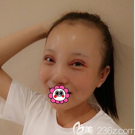 黑龍江瑞麗切開雙眼皮術(shù)后4天