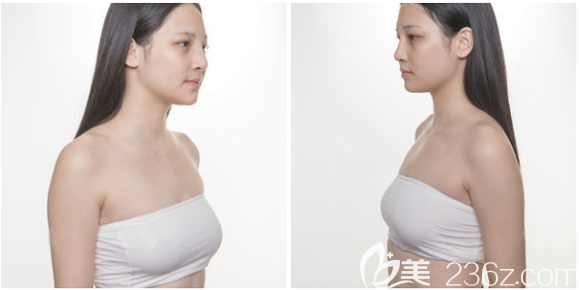 在廣州曙光做隆胸的術(shù)前照片 在廣州曙光做隆胸的術(shù)前照片