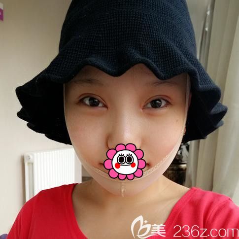 黑龍江瑞麗隆下巴術(shù)后恢復(fù)