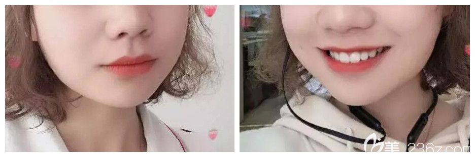 深覆合＋深覆蓋在惠州致美口腔做的金屬鋼絲矯正 624天下牙套后媽媽都驚呆了