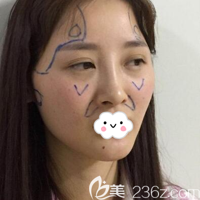 王立鵬脂肪填充術(shù)前設(shè)計圖 王立鵬脂肪填充術(shù)前設(shè)計圖