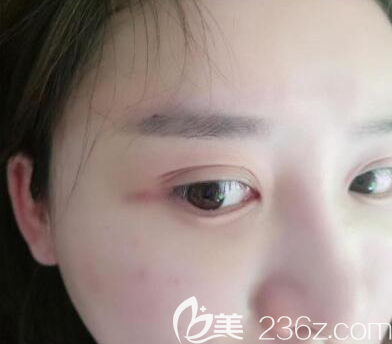 自體脂肪面部填充術(shù)后5天恢復(fù)情況 自體脂肪面部填充術(shù)后5天恢復(fù)情況