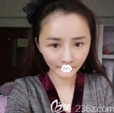 王立鵬全面部脂肪填充術(shù)后即刻 王立鵬全面部脂肪填充術(shù)后即刻