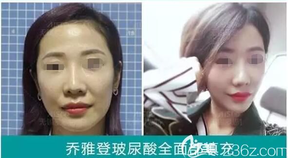 <!--<i data=20240703-sp></i>-->艷醫(yī)生喬雅登玻尿酸填充全面部案例對(duì)比