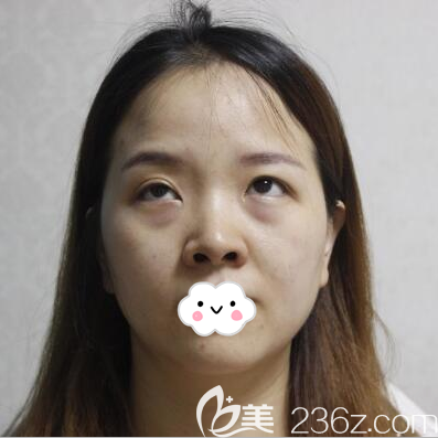 去眼袋手術(shù)前照片 去眼袋手術(shù)前照片