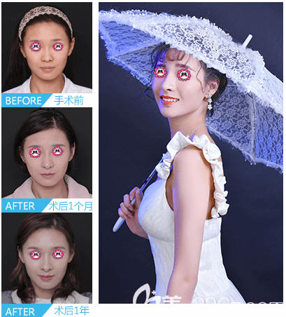 北京沃爾整形劉彥軍醫(yī)生半肋鼻綜合隆鼻案例 北京沃爾整形劉彥軍醫(yī)生半肋鼻綜合隆鼻案例