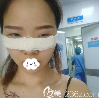 程紅濤內(nèi)切去眼袋術(shù)后即刻 程紅濤內(nèi)切去眼袋術(shù)后即刻