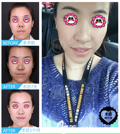 北京沃爾整形劉彥軍醫(yī)生疑難鼻修復(fù)案例 北京沃爾整形劉彥軍醫(yī)生疑難鼻修復(fù)案例