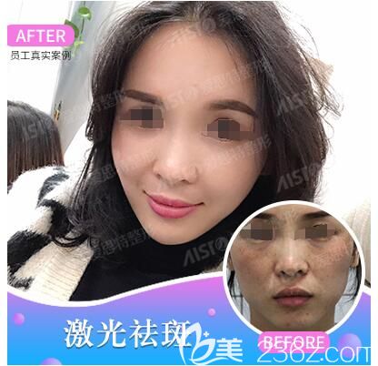 范紅梅醫(yī)生激光祛斑案例對比照