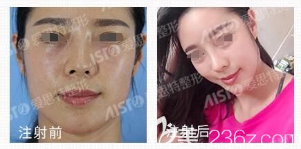高飛注射瘦臉+玻尿酸豐蘋(píng)果機(jī)對(duì)比案例