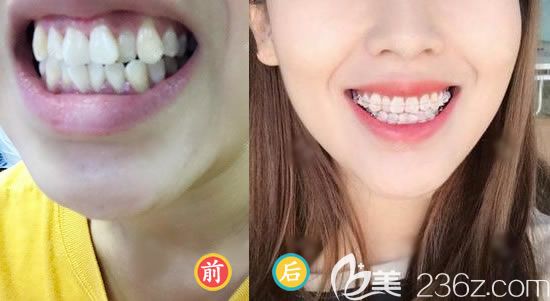 溫州藝星賀真海牙齒矯正案例 溫州藝星賀真海牙齒矯正案例