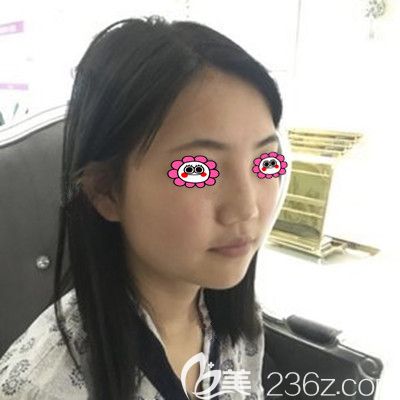 做隆鼻前的照片 做隆鼻前的照片