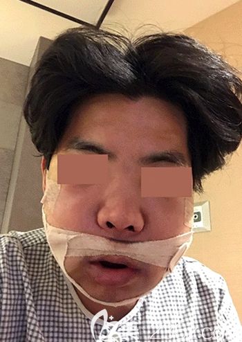 在韓國(guó)faceline做面部輪廓手術(shù)后3天