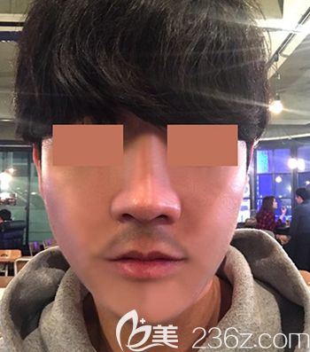 在韓國(guó)faceline做面部輪廓手術(shù)后1個(gè)月