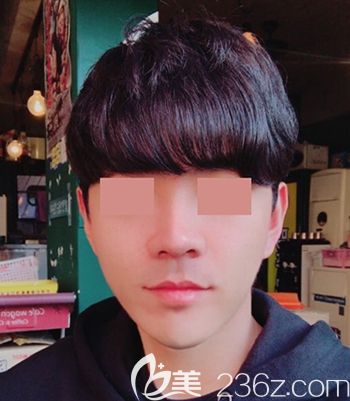 在韓國(guó)faceline做面部輪廓手術(shù)后3個(gè)月