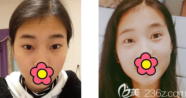 想在呼和浩特割雙眼皮的朋友 看一下呼市五洲王煥醫(yī)生打造的眼部整形案例